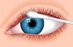 Blepharitis Treatment